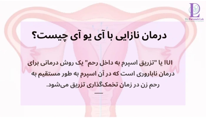 درمان نازایی با آی یو آی چیست؟