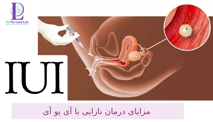 مزایای آی یو آی