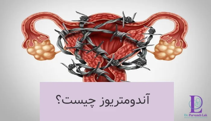آندومتریوز چیست؟
