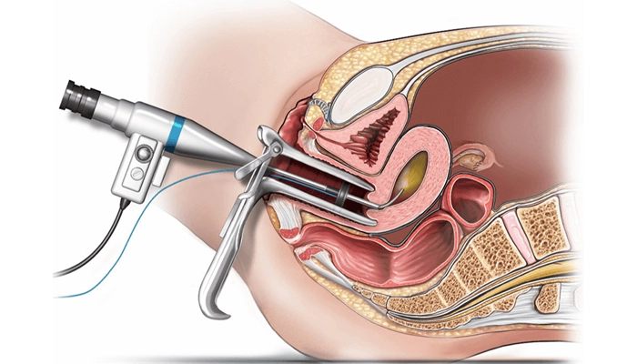 روند خراش اندومتر