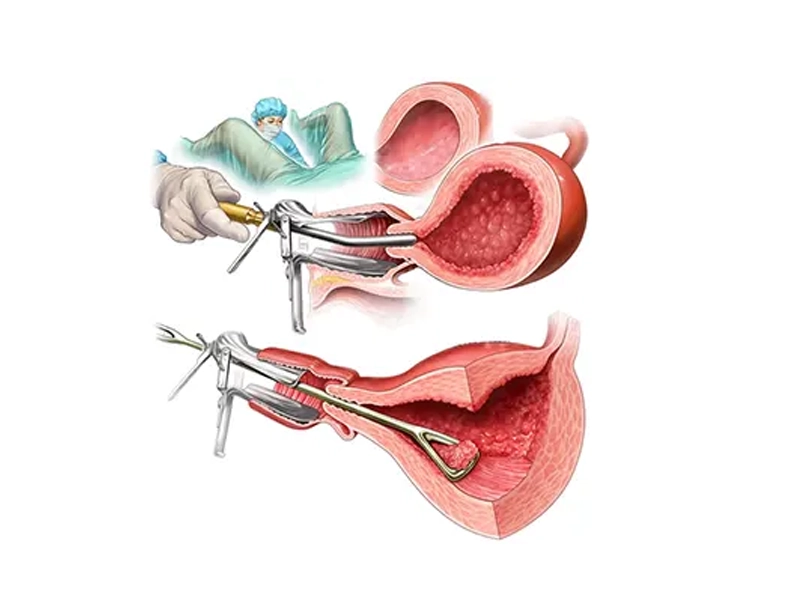 نقش سن زن در موفقیت انتقال جنین