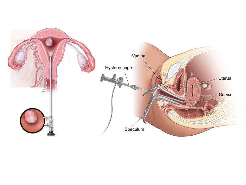 اقدامات پس از هیستروسکوپی